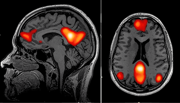 fMRI brain scan showing red-highlighted brain regions associated with emotional or cognitive activity.